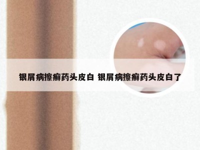 银屑病擦癣药头皮白 银屑病擦癣药头皮白了
