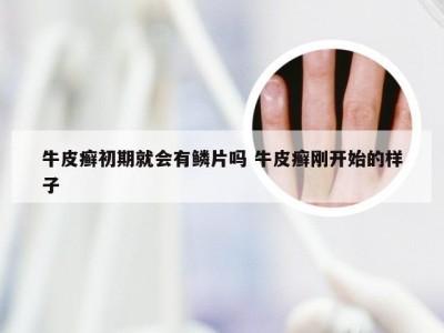 牛皮癣初期就会有鳞片吗 牛皮癣刚开始的样子