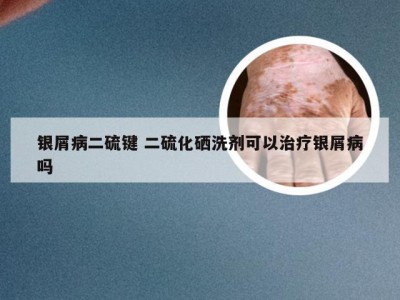 银屑病二硫键 二硫化硒洗剂可以治疗银屑病吗