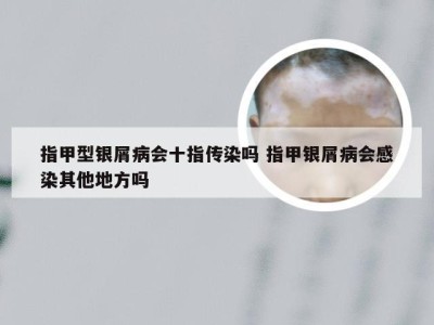 指甲型银屑病会十指传染吗 指甲银屑病会感染其他地方吗
