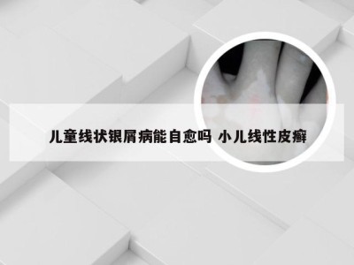 儿童线状银屑病能自愈吗 小儿线性皮癣