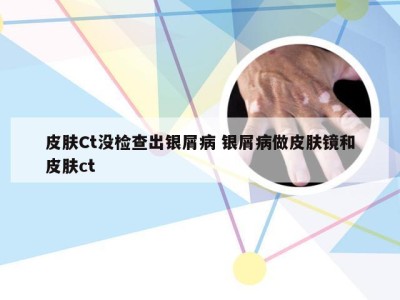 皮肤Ct没检查出银屑病 银屑病做皮肤镜和皮肤ct