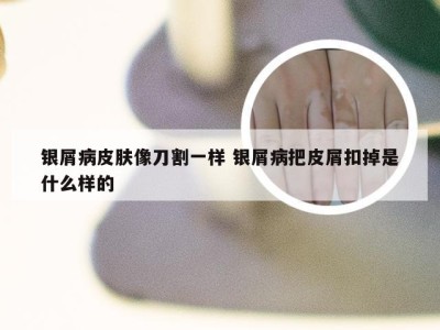 银屑病皮肤像刀割一样 银屑病把皮屑扣掉是什么样的