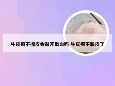 牛皮癣不撕皮会裂开出血吗 牛皮癣不脱皮了