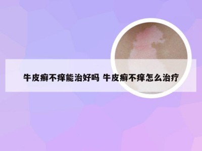 牛皮癣不痒能治好吗 牛皮癣不痒怎么治疗