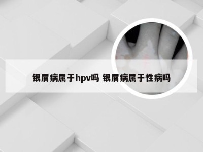 银屑病属于hpv吗 银屑病属于性病吗