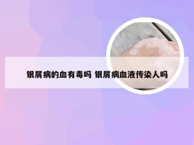 银屑病的血有毒吗 银屑病血液传染人吗