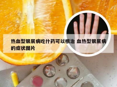 热血型银屑病吃什药可以根治 血热型银屑病的症状图片