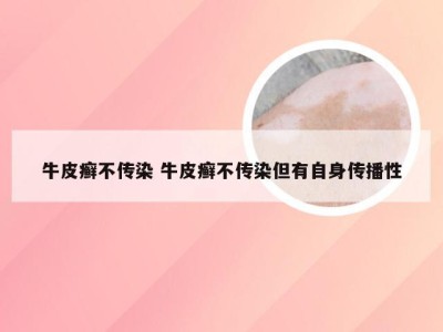牛皮癣不传染 牛皮癣不传染但有自身传播性