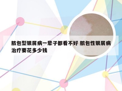 脓包型银屑病一辈子都看不好 脓包性银屑病治疗要花多少钱