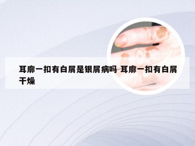 耳廓一扣有白屑是银屑病吗 耳廓一扣有白屑干燥