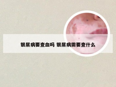 银屑病要查血吗 银屑病需要查什么
