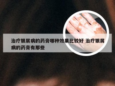 治疗银屑病的药膏哪种效果比较好 治疗银屑病的药膏有那些