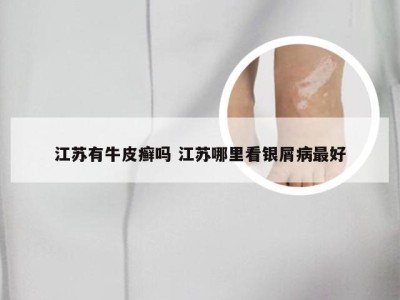 江苏有牛皮癣吗 江苏哪里看银屑病最好