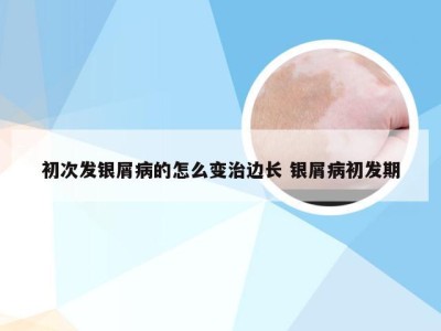 初次发银屑病的怎么变治边长 银屑病初发期