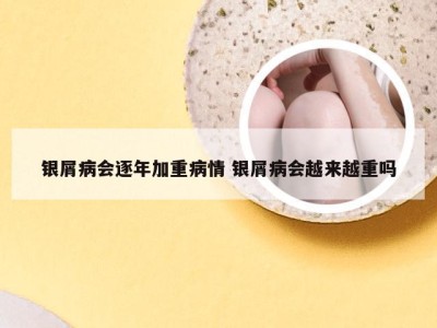 银屑病会逐年加重病情 银屑病会越来越重吗