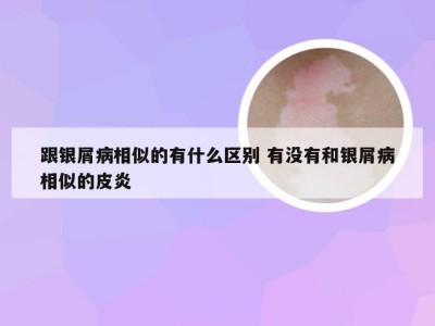 跟银屑病相似的有什么区别 有没有和银屑病相似的皮炎