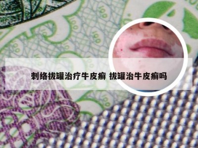 刺络拔罐治疗牛皮癣 拔罐治牛皮癣吗