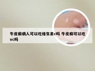 牛皮癣病人可以吃维生素c吗 牛皮癣可以吃vc吗