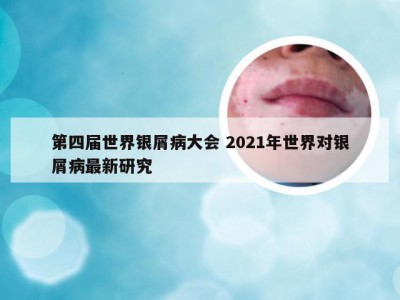第四届世界银屑病大会 2021年世界对银屑病最新研究