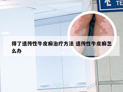 得了遗传性牛皮癣治疗方法 遗传性牛皮癣怎么办