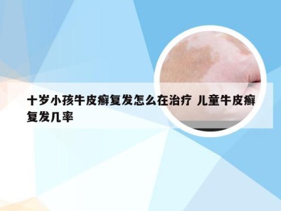 十岁小孩牛皮癣复发怎么在治疗 儿童牛皮癣复发几率