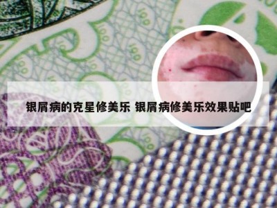 银屑病的克星修美乐 银屑病修美乐效果贴吧