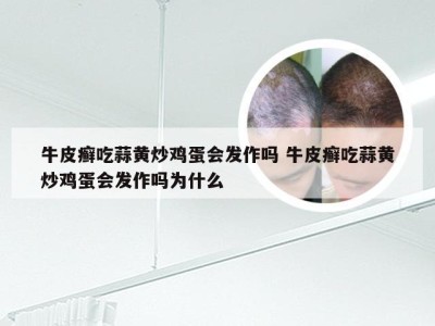 牛皮癣吃蒜黄炒鸡蛋会发作吗 牛皮癣吃蒜黄炒鸡蛋会发作吗为什么