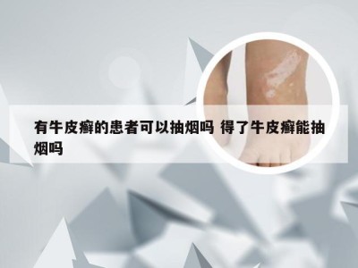 有牛皮癣的患者可以抽烟吗 得了牛皮癣能抽烟吗