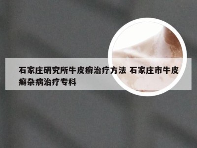 石家庄研究所牛皮癣治疗方法 石家庄市牛皮癣杂病治疗专科