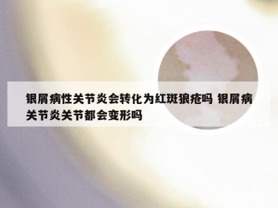 银屑病性关节炎会转化为红斑狼疮吗 银屑病关节炎关节都会变形吗