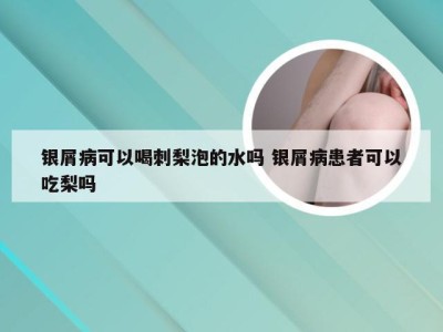 银屑病可以喝刺梨泡的水吗 银屑病患者可以吃梨吗