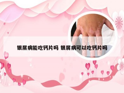 银屑病能吃钙片吗 银屑病可以吃钙片吗