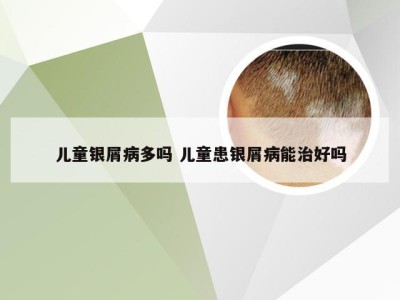 儿童银屑病多吗 儿童患银屑病能治好吗