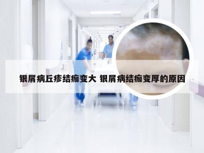 银屑病丘疹结痂变大 银屑病结痂变厚的原因
