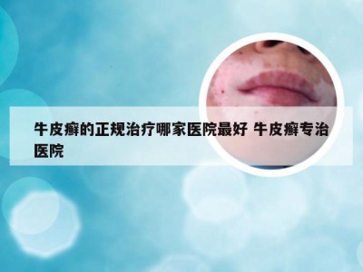 牛皮癣的正规治疗哪家医院最好 牛皮癣专治医院