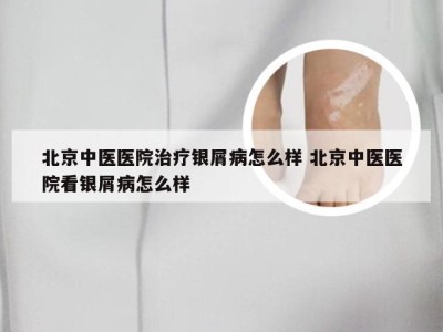 北京中医医院治疗银屑病怎么样 北京中医医院看银屑病怎么样