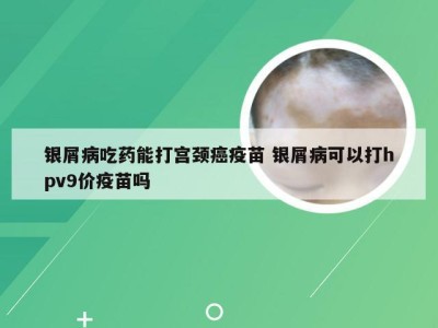 银屑病吃药能打宫颈癌疫苗 银屑病可以打hpv9价疫苗吗