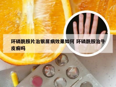 环磷酰胺片治银屑病效果如何 环磷酰胺治牛皮癣吗