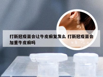 打新冠疫苗会让牛皮癣复发么 打新冠疫苗会加重牛皮癣吗