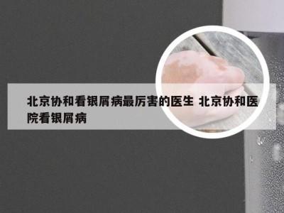 北京协和看银屑病最厉害的医生 北京协和医院看银屑病