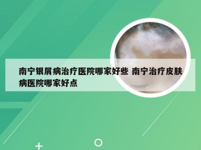 南宁银屑病治疗医院哪家好些 南宁治疗皮肤病医院哪家好点