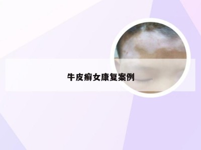 牛皮癣女康复案例
