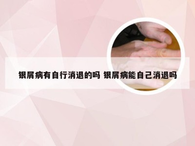 银屑病有自行消退的吗 银屑病能自己消退吗