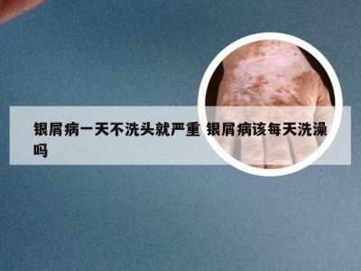 银屑病一天不洗头就严重 银屑病该每天洗澡吗