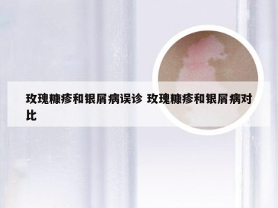 玫瑰糠疹和银屑病误诊 玫瑰糠疹和银屑病对比