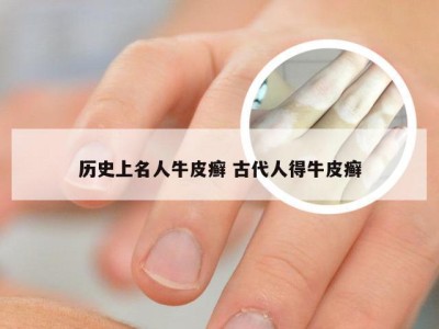 历史上名人牛皮癣 古代人得牛皮癣