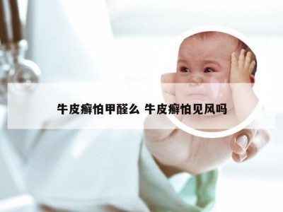 牛皮癣怕甲醛么 牛皮癣怕见风吗