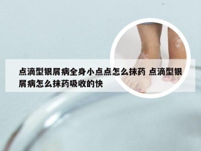 点滴型银屑病全身小点点怎么抹药 点滴型银屑病怎么抹药吸收的快