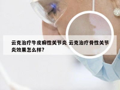 云克治疗牛皮癣性关节炎 云克治疗骨性关节炎效果怎么样?